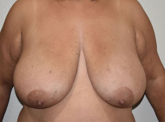 Breast Reduction Case 195 - Before