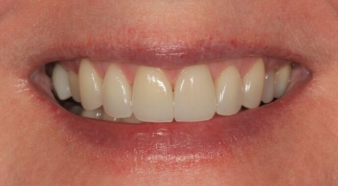Porcelain Veneers Case 33 - After