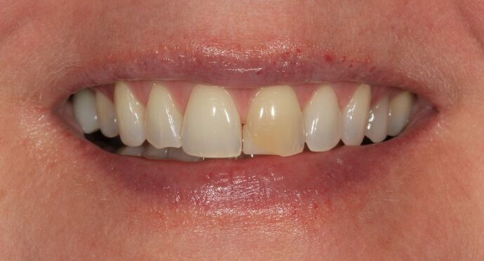 Porcelain Veneers Case 33 - Before