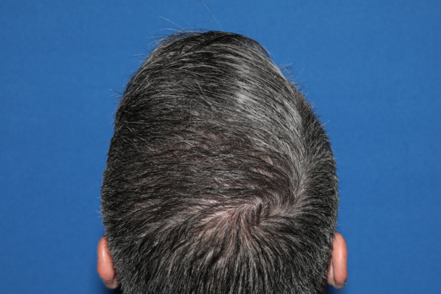Hair Transplants: Case 8 - Crown FUE Transplant - After