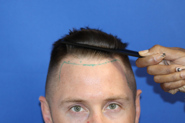 Hair Transplants: Case 9 - Frontal Hairline Transplant - Before