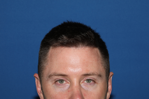 Hair Transplants: Case 9 - Frontal Hairline Transplant - After
