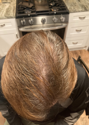 Hair Transplants: Case 10 - FUE for Frontal Density with Scalp & Beard Grafts - After