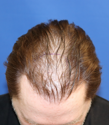 Hair Transplants: Case 10 - FUE for Frontal Density with Scalp & Beard Grafts - Before