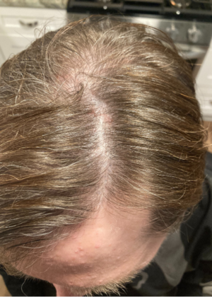 Hair Transplants: Case 10 - FUE for Frontal Density with Scalp & Beard Grafts - After