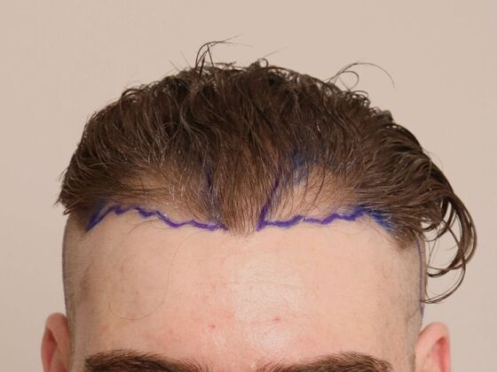 Male Before And After Hair Transplant Photos Hairline FUE (6) - Before