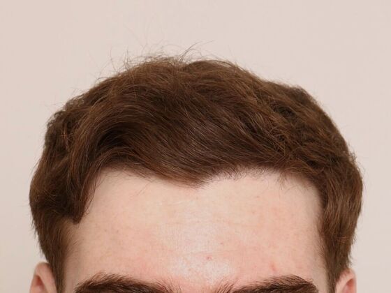 Male Before And After Hair Transplant Photos Hairline FUE (6) - After