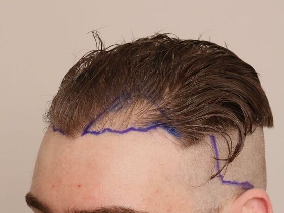 Hair Transplant - Male: Hairline FUE - Case 6 - Before FUE hair transplant