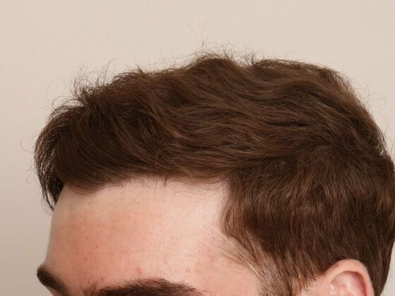 Hair Transplant - Male: Hairline FUE - Case 6 - After FUE hair transplant