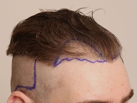 Hair Transplant - Male: Hairline FUE - Case 6 - Before FUE hair transplant