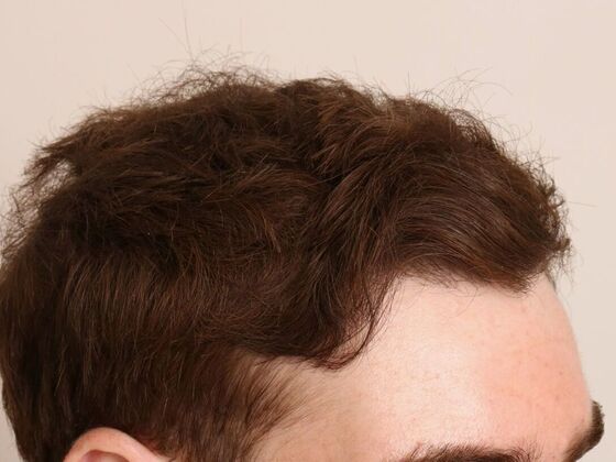 Hair Transplant - Male: Hairline FUE - Case 6 - After FUE hair transplant