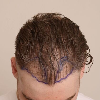 Hair Transplant - Male: Hairline FUE - Case 6 - Before FUE hair transplant