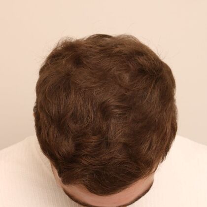 Hair Transplant - Male: Hairline FUE - Case 6 - After FUE hair transplant