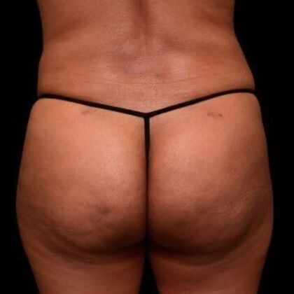 Brazilian Butt Lift Case 5 - After
