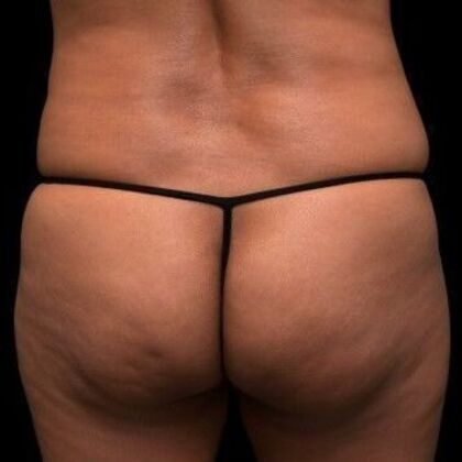 Brazilian Butt Lift Case 5 - Before