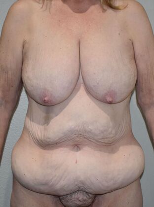 Massive Weight Loss : Case 171 - Before