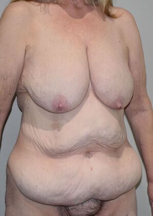 Massive Weight Loss : Case 171 - Before