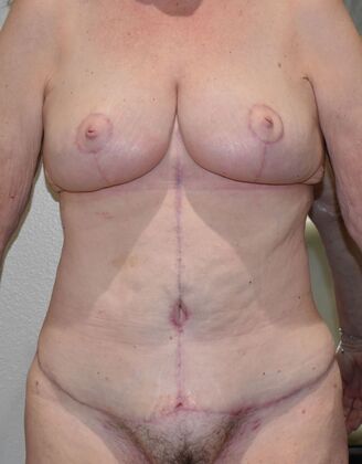 Massive Weight Loss : Case 171 - After