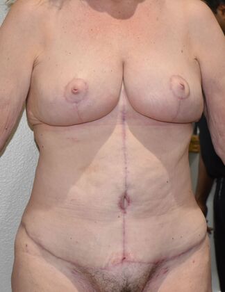 Massive Weight Loss : Case 171 - After