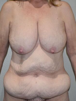Mommy Makeover Case 336 - Before