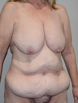 Mommy Makeover: Case 336 - Before