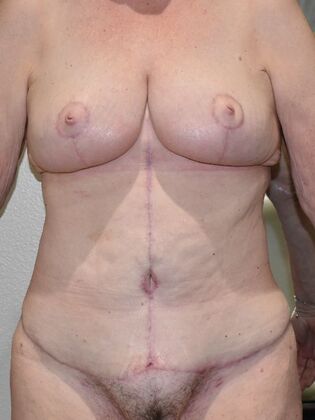 Mommy Makeover Case 336 - After