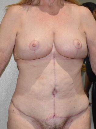 Mommy Makeover: Case 336 - After
