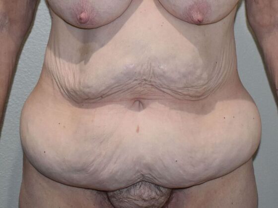 Tummy Tuck (Abdominoplasty) Case 530 - Before