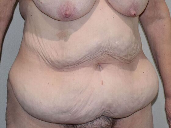 Tummy Tuck (Abdominoplasty): Case 530 - Before