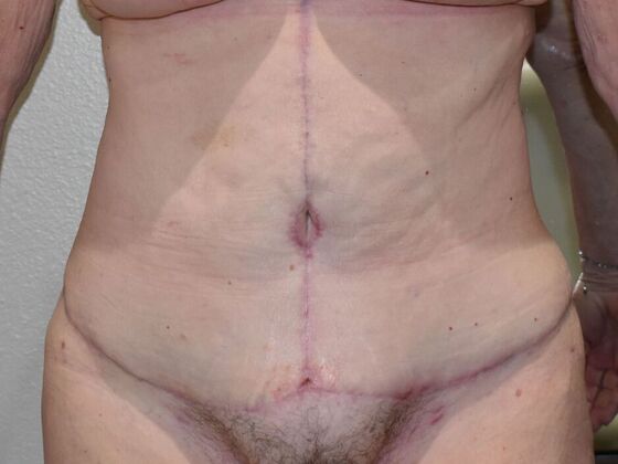 Tummy Tuck (Abdominoplasty) Case 530 - After