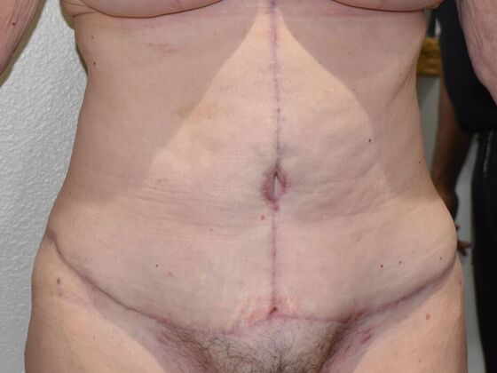 Tummy Tuck (Abdominoplasty): Case 530 - After