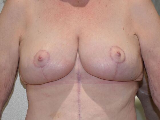 Breast Lift (Mastopexy) Case 239 - After