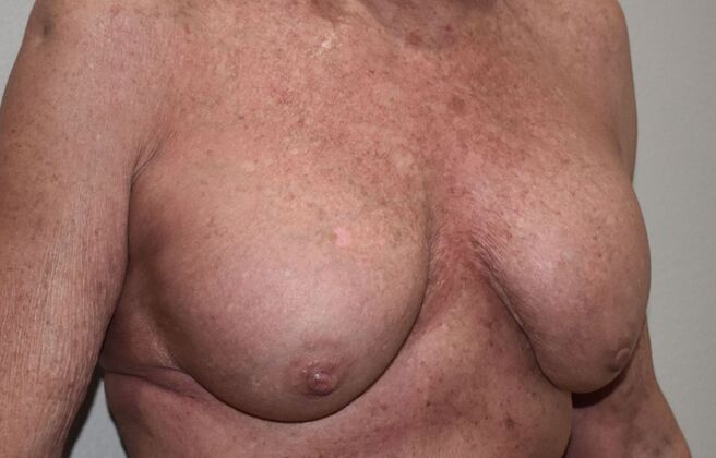 Breast Revision: Case 290 - Before