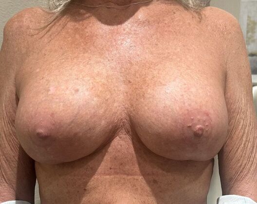 Breast Revision: Case 290 - After