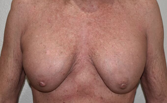 Breast Augmentation w/ Lift Case 589 - Before