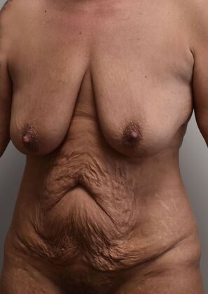 Massive Weight Loss : Case 172 - Before