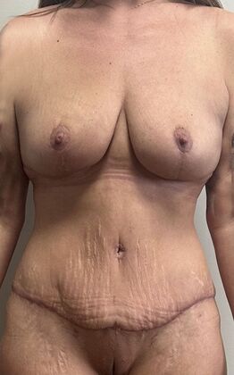 Massive Weight Loss : Case 172 - After