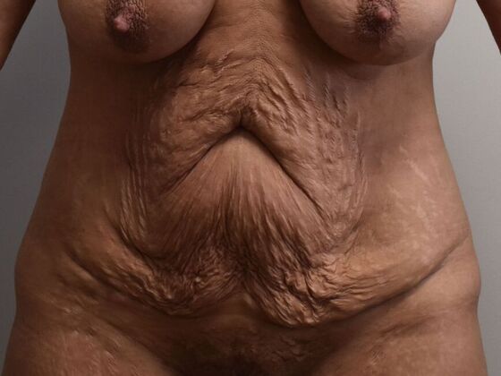 Tummy Tuck (Abdominoplasty) Case 531 - Before