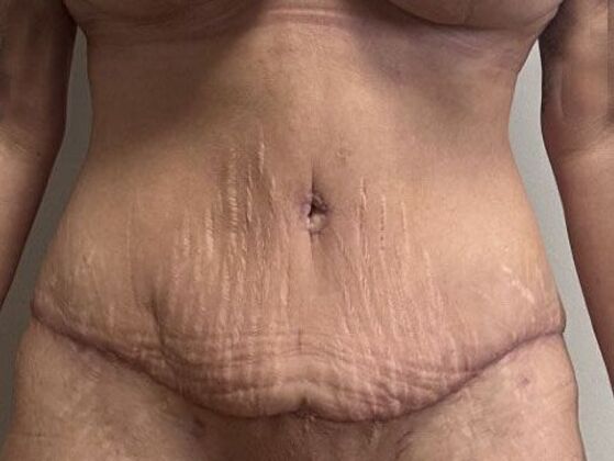 Tummy Tuck (Abdominoplasty): Case 531 - After