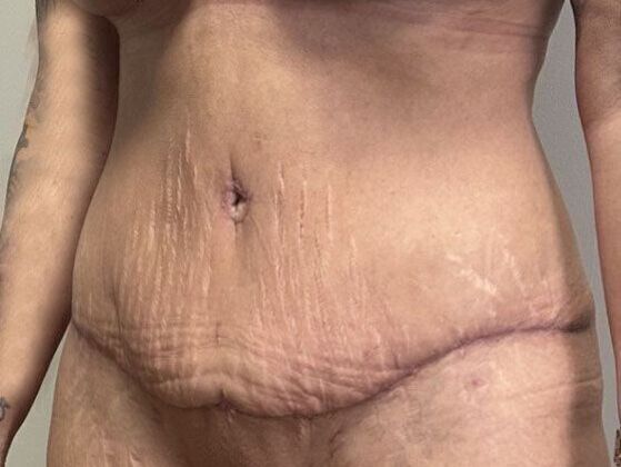 Tummy Tuck (Abdominoplasty): Case 531 - After