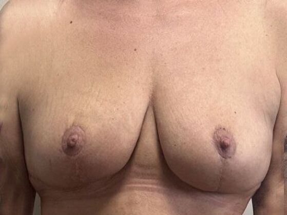 Breast Lift (Mastopexy): Case 240 - After