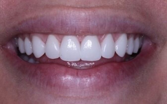 Veneers: Dina - After