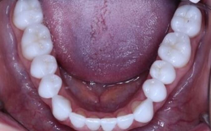 Veneers: Dina - After