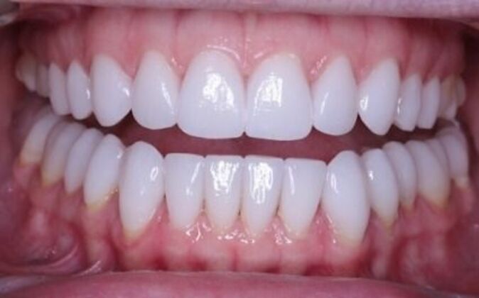 Veneers Cases