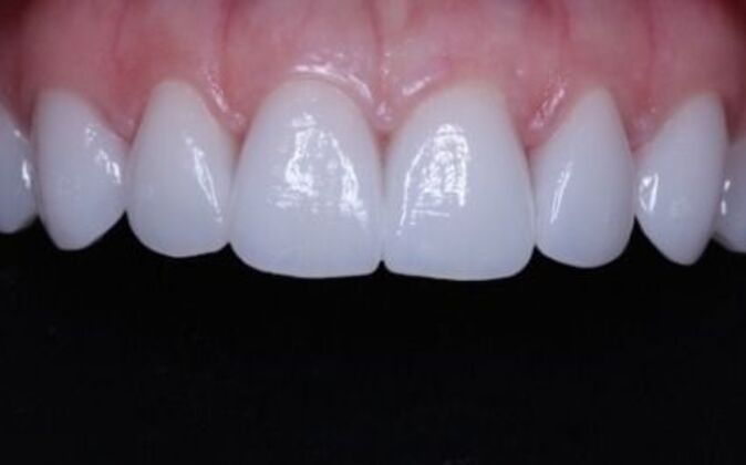 Veneers: Dina - After