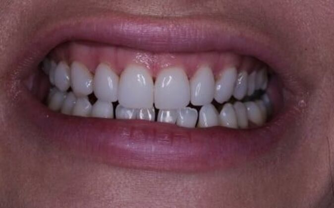 Veneers Dina - Before