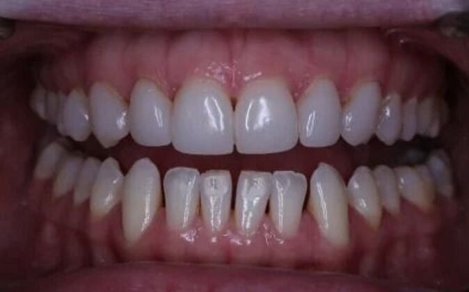 Veneers: Dina - Before