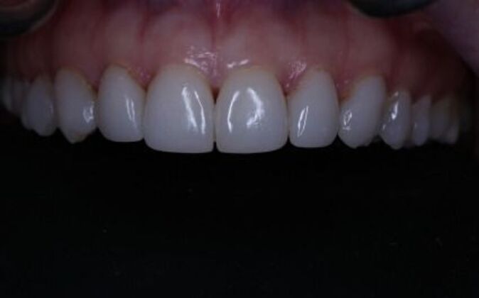 Veneers: Dina - Before