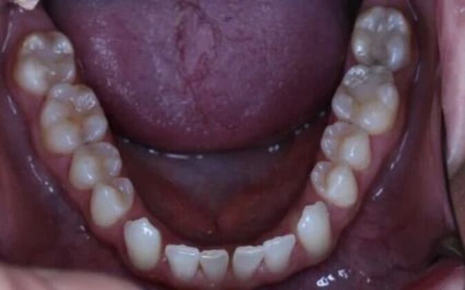 Veneers: Dina - Before