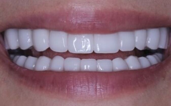 Full Mouth Reconstruction Cases